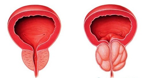 河池前列腺囊肿的典型表现有哪些 河池前列腺囊肿的典型表现有哪些