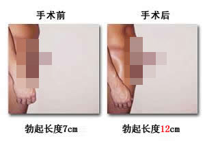 医生介绍阴茎短小怎样延长！