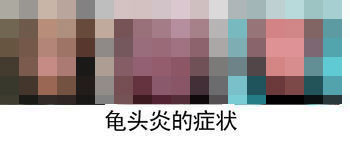 包皮龟头炎如何治疗？