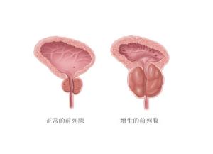 前列腺肥大的危害有哪些