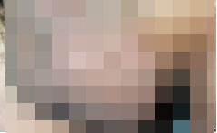 河池精索静脉曲张手术